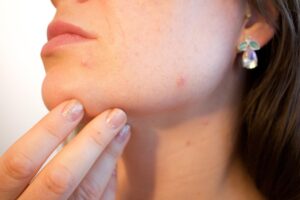 フェイシャルエステで毛穴の悩みを解消する方法は？
